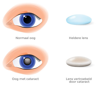 implantlenzen cataract