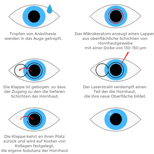 Laserbehandlungs Augen